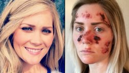 Joven se tomó foto para crear conciencia sobre cáncer de piel
