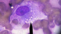 Hallan proteína ‘crucial’ en el desarrollo del cáncer de mama