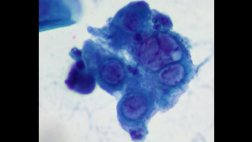 Modifican el virus del herpes para combatir el cáncer de piel