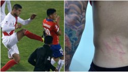 Así quedó espalda de Aránguiz tras la patada de Carlos Zambrano