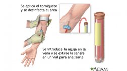 La mayoría de cánceres de próstata no necesitarían tratamiento