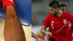 Carlos Zambrano sufrió terrible herida en duelo ante Colombia