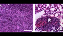 Crean dispositivo que detecta reaparición del cáncer de mama