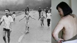 "La niña del napalm" quiere vencer el dolor con láser