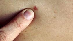 ¿Cómo identificar lunares posiblemente cancerosos?