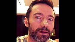 Hugh Jackman reconoce que le recrudeció cáncer de piel