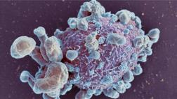 La terapia para el cáncer de mama que redujo tumores en 11 días