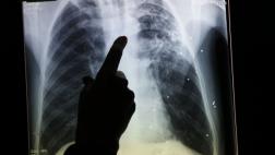 Cáncer: personal médico expuesto a rayos X tiene más riesgo