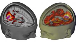 ¿Qué le ocurre al cerebro cuando se consume LSD?