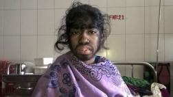 La dramática historia de la "niña lobo" de Bangladesh