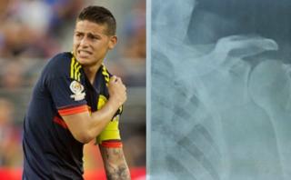 James Rodríguez: su lesión en el hombro preocupa a Colombia