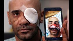 Los palestinos heridos de por vida por balas de goma de Israel