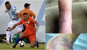 Alexis Sánchez publicó impactante foto de su tobillo maltrecho 