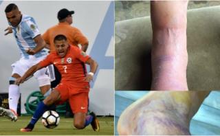 Alexis Sánchez publicó impactante foto de su tobillo maltrecho 