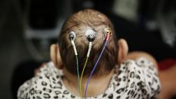 EE.UU.: El 6% de bebes de madres con zika tiene malformaciones
