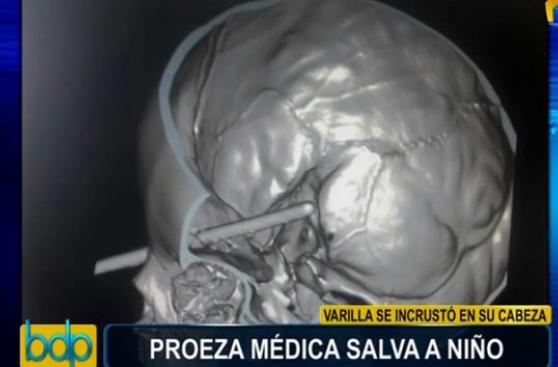 Médicos salvan a niño que tenía incrustada varilla en la cabeza