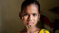 Operan con éxito a la 'niña árbol' de Bangladesh