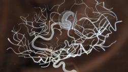 ¿Qué es la enfermedad de Alzheimer?