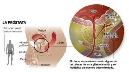 Nuevas guías para la detección precoz del cáncer de la próstata