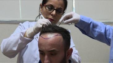 Turquía, el destino para realizarse transplantes de cabello