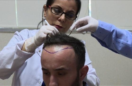 Turquía, el destino para realizarse transplantes de cabello